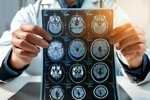 Stroke Speech Problems